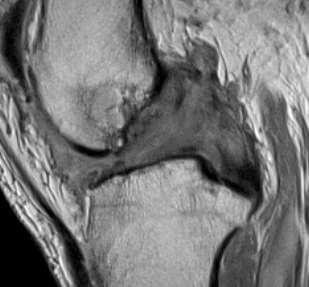 Ligamento cruzado posterior RM: Completas Interrupção das fibras de espessura completa