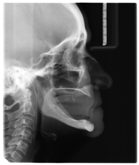 37 a b c Figura 1- Exames radiográficos iniciais: a) Radiografia panorâmica b)telerradiografia de perfil c) Tomografia Computadorizada por Feixe