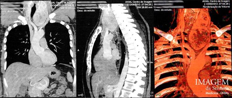 Imagem da Semana: Radiografia, Tomografia computadorizada Figura 1: Radiografia de tórax em incidência póstero anterior