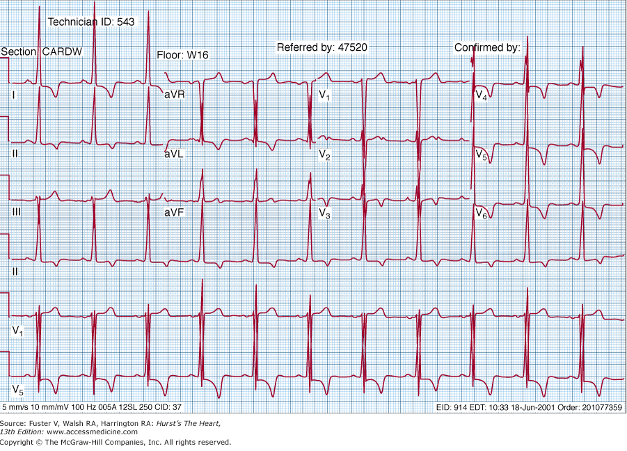 Figura 4 - Alterações electrocardiográficas na CMH O Doppler facilita a visualização do processo fisiopatológico, e pode revelar-se útil na distinção da hipertrofia fisiológica da patológica através