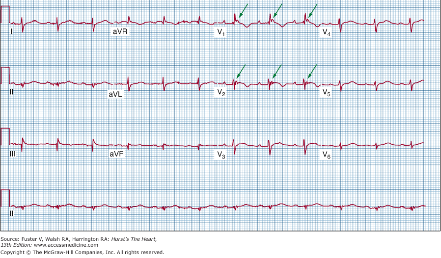 (potenciais tardios) nas porções terminais dos complexos QRS em V 1 a V 3 (figura 14) 33.