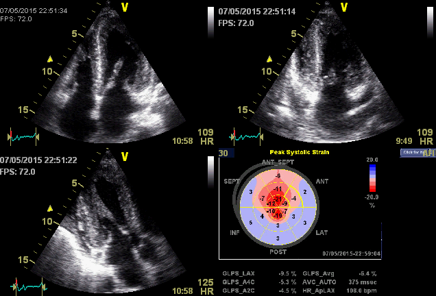 Deformação miocárdica (Strain/Strain rate) Auxiliar de diagnóstico Na amiloidose apical sparing CA is characterised by regional variations in LS from base to apex.