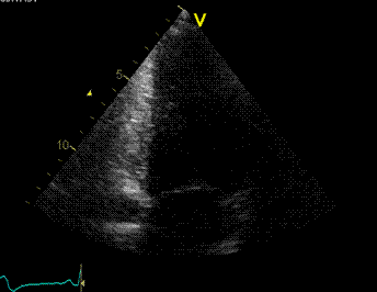 assunções de uma geometria ventricular simétrica errado em ventrículos dilatados, aneurismáticos ou com alterações da cinética segmentar -