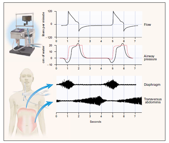 24 Figura 2: Eletroneuromiografia dos músculos diafragma e transverso do abdome em pacientes portadores de DPOC durante a PSV Fonte: (TOBIN, 2001).