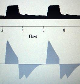 98 APÊNDICE B: Curvas ventilatórias da tela dos ventiladores estudados. - Padrão característico de ciclagem precoce.