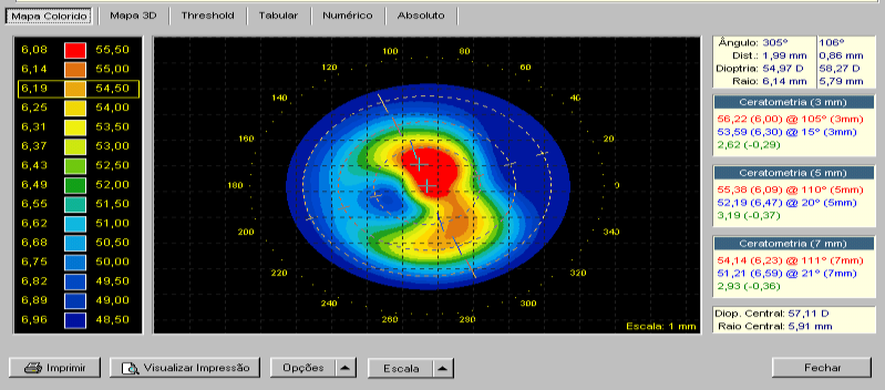 14. MAPA AXIAL A curvatura axial é usada para cálculos de poder refrativo em todos os sistemas de topografia.