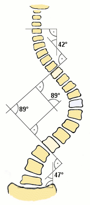 7 Como se pode observar, Martins (2001) aponta os três (3) tipos de escoliose e suas possíveis causas.