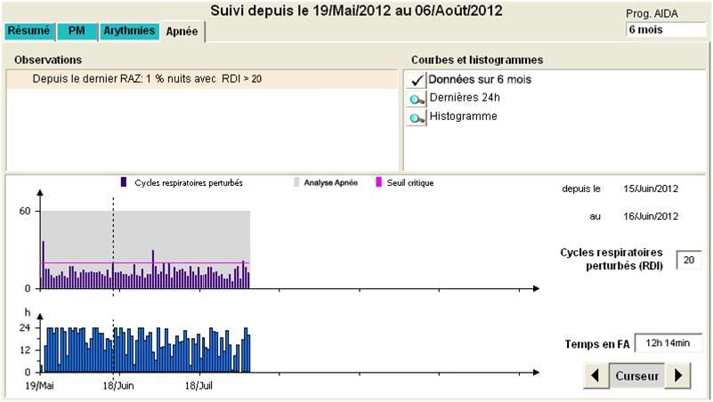 Apneia do Sono Reply 200 Funcionamento do algoritmo (SAM) Limiar de Severidade: