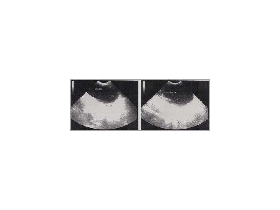 FIGURA 1: Avaliação ultrassonográfica da vesícula urinária: Presença de sedimentos, cristais e celularidade intensa (cistite bacteriana). Fonte: Clínica Animal s.