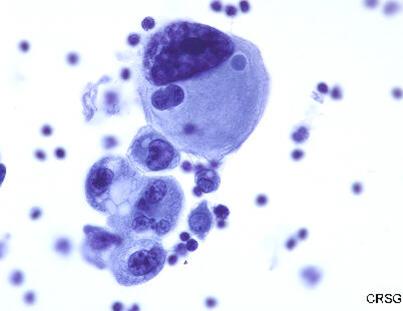 Resultados do II Prolla, JC. Exame de Citologia: Derrame Pleural Positivo. Aumento 500x.