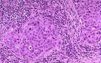 Carcinoma medular(mama) - variante rara do Ca ductal (1%)