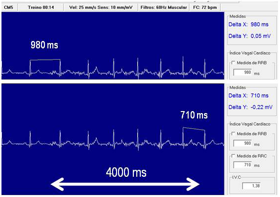 Medida do Índice Vagal Cardíaco (IVC) O registro eletrocardiográfico a 25 mm/s e com 35 segundos de duração era iniciado cinco segundos antes do primeiro comando verbal do avaliador.