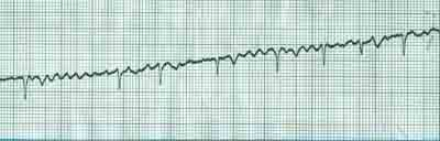 Fibrilação Atrial Fibrilação Atrial Diagnóstico Eletrocardiográfico Ausência da onda P Presença de onda f (geralmente em V 1 ) Espaços R-R variáveis QRS normal v 1 (ondas F) v 1 Características