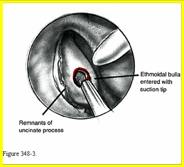 Abertura da lamela basal e etmoidectomia posterior Se houver envolvimento do etmóide posterior, este é abordado através da lamela basal (porção diagonal da concha média).