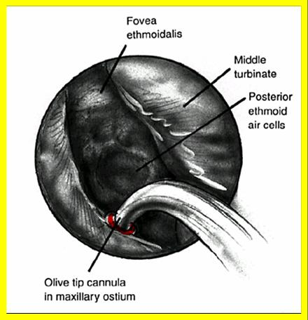 Técnica póstero-anterior A esfenoetmoidectomia total é reservada para pacientes com sinusite e polipose extensa envolvendo todos os seios paranasais ipsilaterais ou bilaterais.