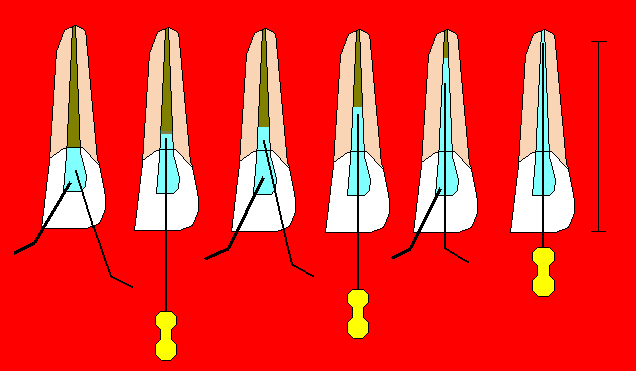 III II I Figura 2. Neutralização progressiva. Observar a renovação da solução irrigante na medida em que se aprofunda a lima no interior do canal radicular.