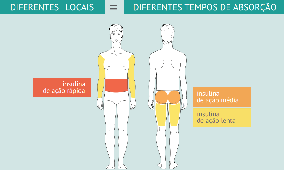 preferencialmente para as injeções de insulina de ação intermédia, sendo a região das nádegas uma boa alternativa.