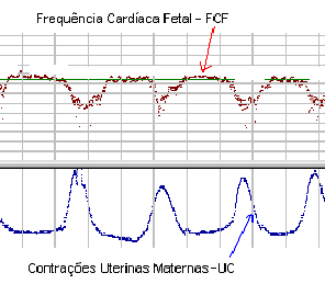 Figura 1 Sinais FCF e UC em um exame de CTG. O sinal do exame cardiotocográfico analisado neste projeto é a FCF.