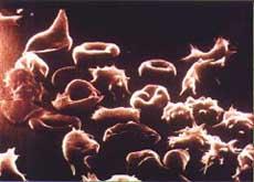 Talassemia = forma de anemia causada pela deficiência na produção de Hb,