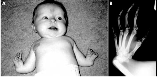 Trombocitopenias Hereditárias TAR Descrita em 1951 Autossômica Recessiva, caracterizada por ausência de radio, trombocitopenia (com defeito no pool de armazenamento), e outras