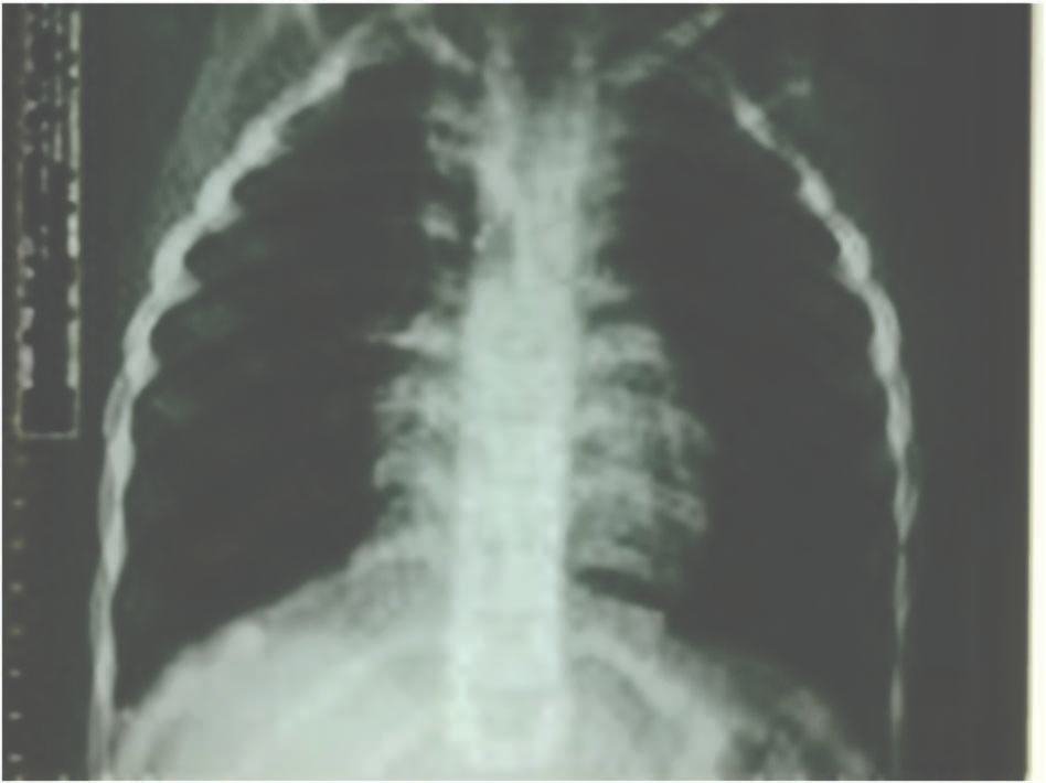 40 Tuberculose pulmonar bacilífera em pré-escolar. - Eugênio Fernandes de Magalhães e cols. normal and non-reactive tuberculin skin test.