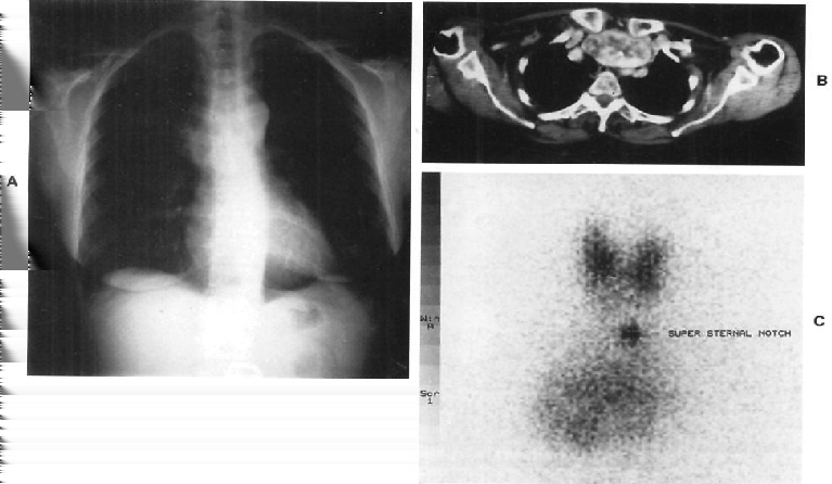 carcinoma papilífero raramente atinge os gânglios linfáticos, porém acarreta metástase em órgãos como o fígado e pulmão, onde são encapsulados e mostram-se elástico à apalpação [8].