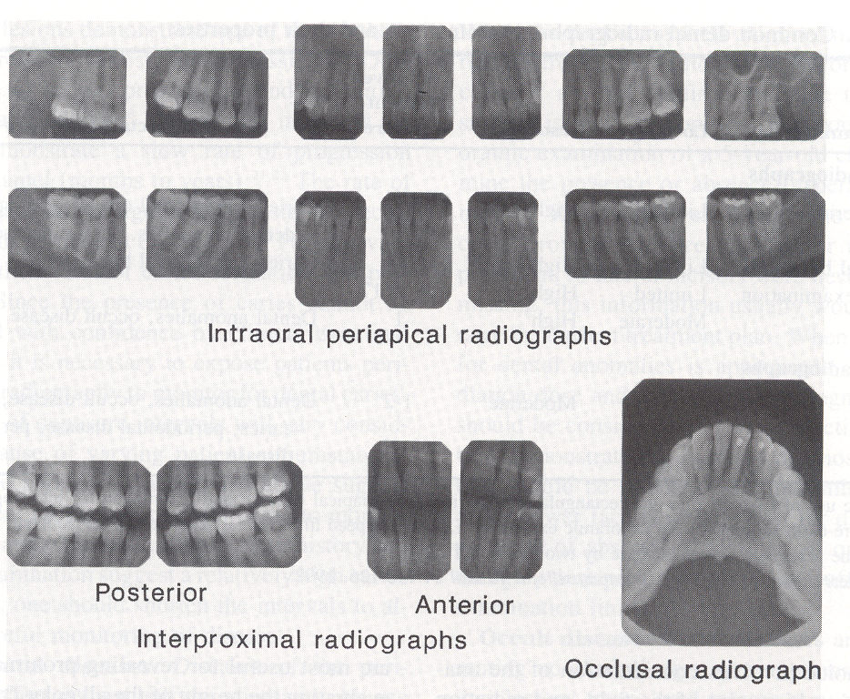 dentes a radiografar devem ser paralelos, quer no sentido
