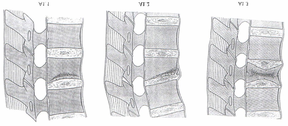 13 Fraturas do Tipo A: compressão do corpo vertebral As fraturas do Tipo A são causadas por força de compressão axial, associada ou não à flexão.