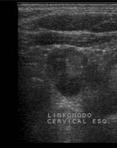 Puramente cístico Misto: sólido/cístico Espongiforme Sólido / hipoecoico Linfonodos cervicais alterados Microcalcificações, margens irregulares Tipo de lesão Fortes Fracos Figura 1 - US de tireoide: