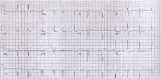 5 meses depois (Set/12): Piora da dispnéia Palpitação há 3 meses FC=120 bpm Edema generalizado ECG: Fibrilação atrial Evolução Parâmetros 2010 (Jun) CF (NYHA) 2010 (Ago) II I I 2012 2012 (Set) 2013