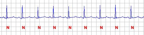 25 3..3 Rtmo Snusal Normal A freqüênca em que os complexos QRS ocorrem é denomnada freqüênca cardíaca (FC), geralmente dada em batmentos por mnuto (bpm).