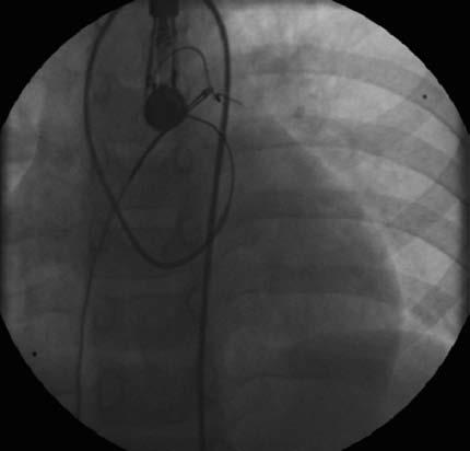 Técnica de laçada arteriovenosa Fio de troca é laçado e passado