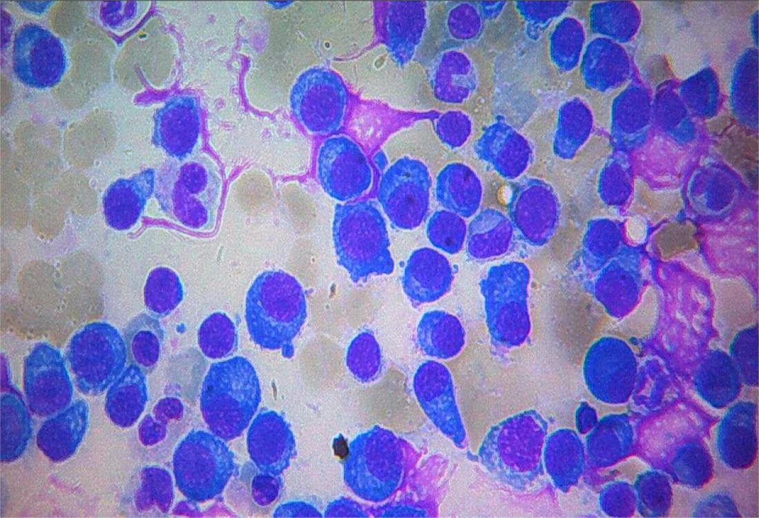 48 forma leucemizada da entidade, denominada de leucemia de células plasmáticas (LCP).