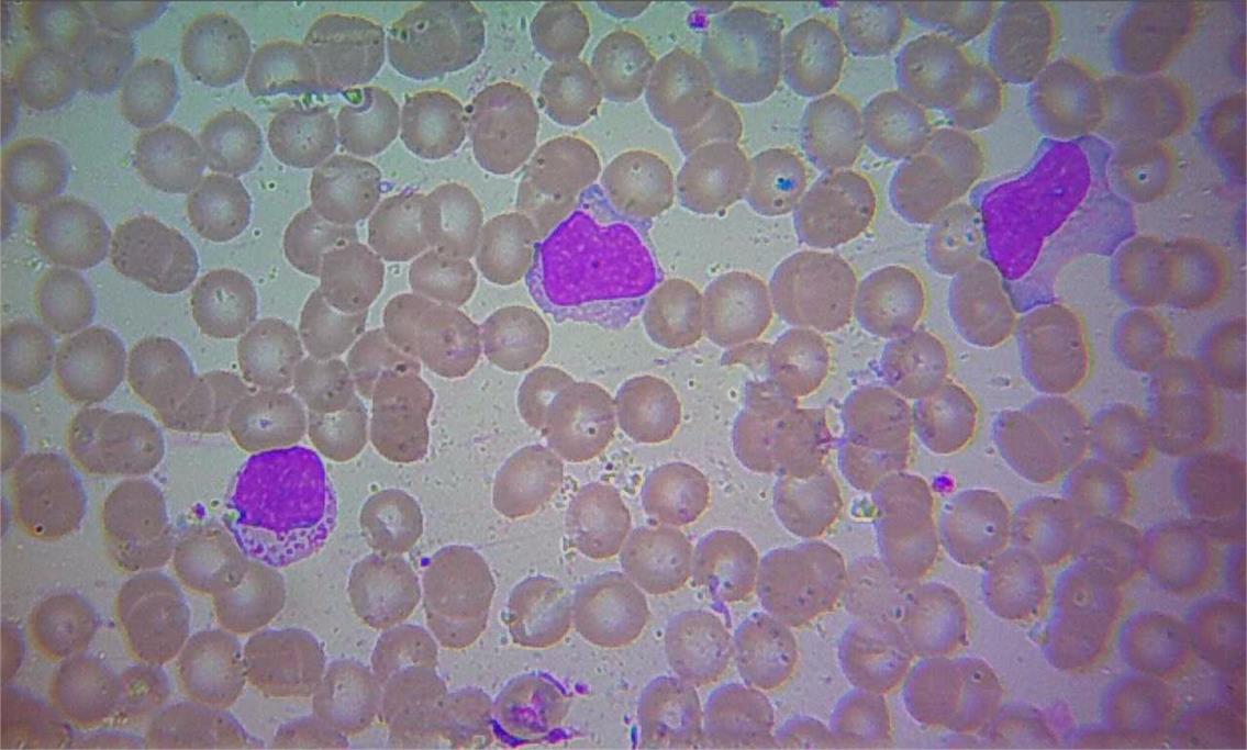 51 Figura 18 - Morfologia de sangue periférico de LGL-T. Figura 19 - Perfil imunofenotípico de LGL-T. 2.6.