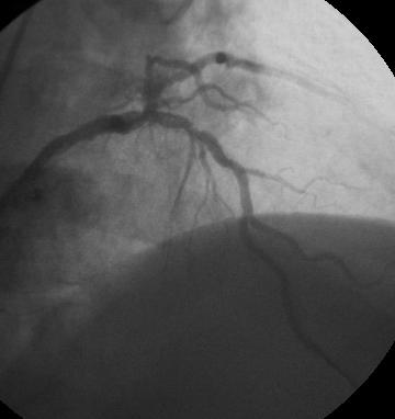 ANGIOPLASTIA-- Julho