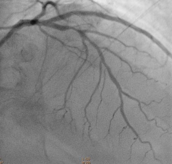 ATC 2010 Como Definir a Melhor Estratégia? Angina Estável DLP Sedentarismo DAC!!!!!!!!! 1 Stent?