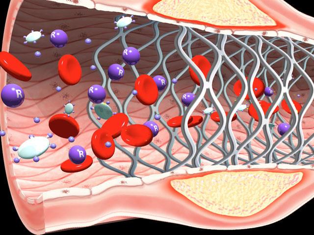 STENT FARMACOLÓGICO / REVESTIDO