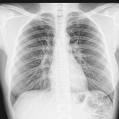 Exames de Imagem- Toxicidade TC de abdome e pélvis : 14 msv TC Tórax: 07 msv PET scan: 14 msv 0,1 msv!! 34 msv!