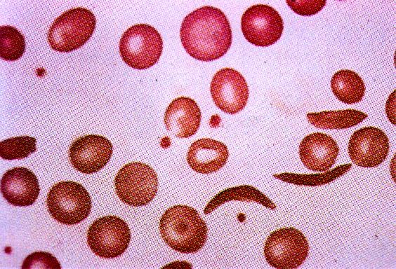 10 Figura 1 Esfregaço de sangue periférico de paciente com anemia falciforme