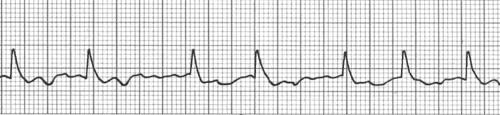 Fibrilação Atrial Diagnóstico Eletrocardiográfico Ausência da onda P Presença