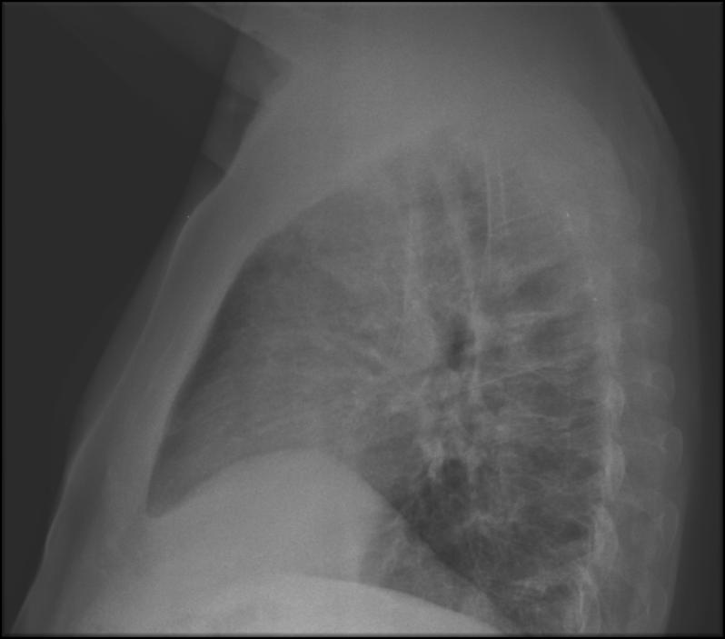 Gasometria arterial e ph ph 7,45; PaCO 2 =37,3 mmhg;