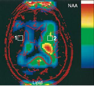 ESPECTROSCOPIA PRINCIPAIS INDICAÇÕES: Lesões focais