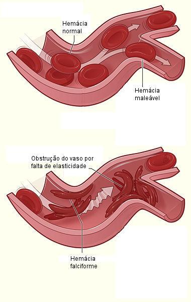 DOENÇA FALCIFORME - FISIOPATOLOGIA Hemácias perdem deformabilidade obstrução vascular e isquemia tecidual Sd Torácica Aguda, Crises Álgicas, Asplenia funcional, AVC.