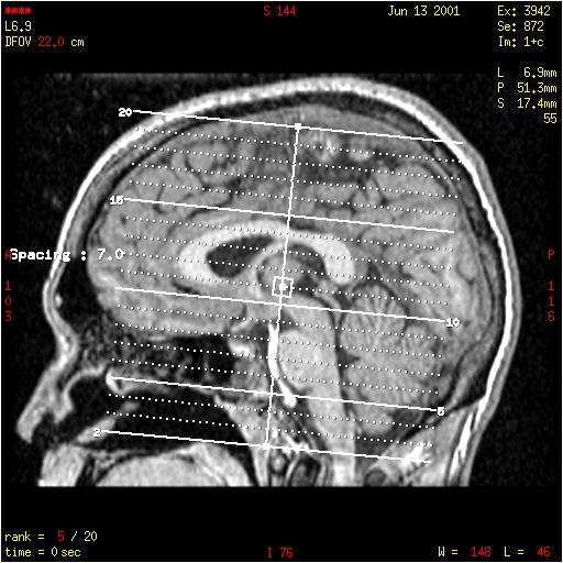 A espectroscopia refere-se ao estudo do hidrogênio ligado à importantes moléculas do metabolismo cerebral, como o N-Acetil Aspartato, a Creatinina, a Colina e o