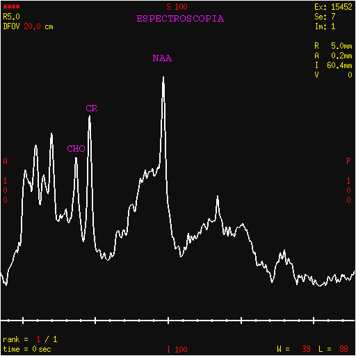 .. Recentemente com o avanço da técnica Echo Planar Image, surgiram os estudos funcionais por RM.