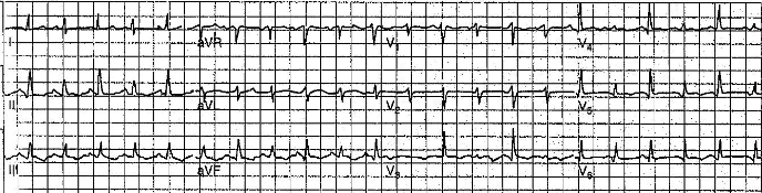 Seu exame de chegada verificou os seguintes sinais PA: 110/70 mmhg; FC: 95 bpm; FR 21 IR/mim; Seu ECG realizado rapidamente na sala de emergência pode ser analisado a seguir.