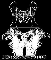 Uma linha reta é traçada entre as margens laterais dos acetábulos, uma linha perpendicular é traçada na borda interna da cabeça femoral e outra na borda lateral do acetábulo.