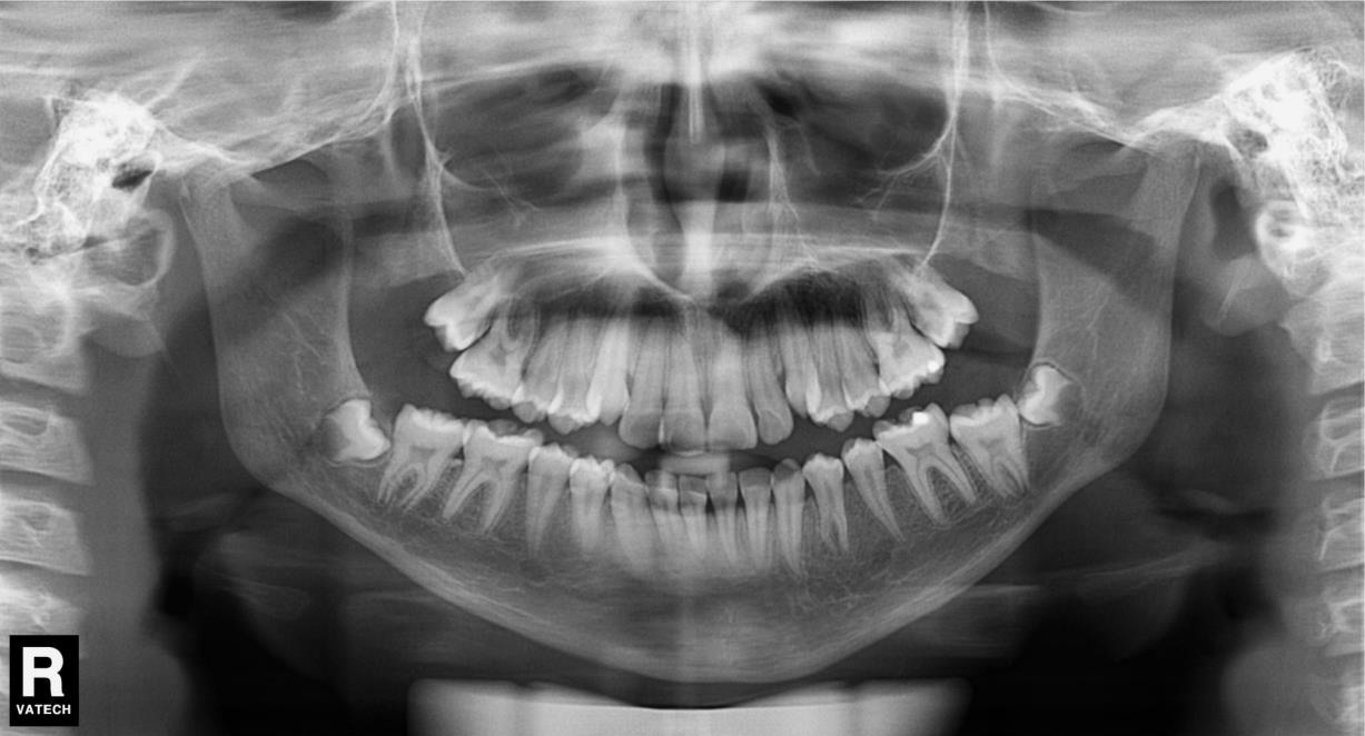 36 Figura 2 Anomalia Dentária - Agenesia Fonte: Doc