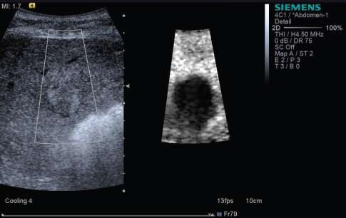 Introdução Virtual Touch Tissue Imaging (VTI) Avaliação Qualitativa Elastograma representa