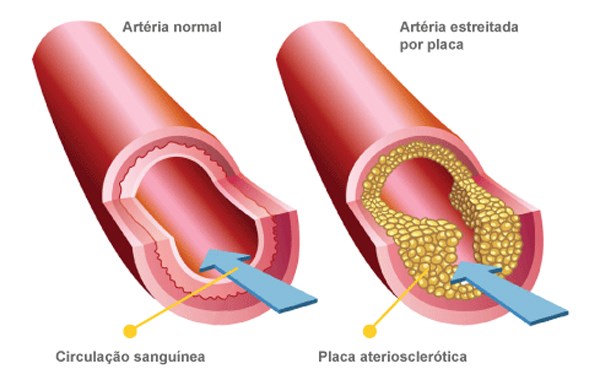 Com atenção, encontrar os seguintes pontos de pulso: (consultar imagem no final deste Guia) -Carotídeo -Braquial -Radial -Inguinal O QUE É O COLESTEROL?